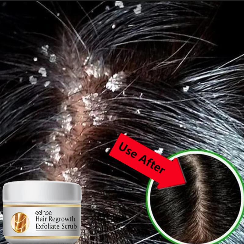 速効性フケ防止ヘアトリートメントスクラブ かゆみ止め頭皮洗浄 - Scalp Scrub Exfoliant のレビューと価格