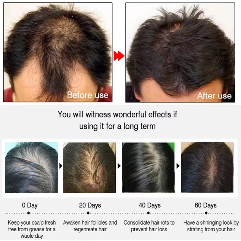 速効性ジンジャーヘアグローススプレー、毛根育成、脱毛防止、育 - Hair Care Natural のレビューと価格